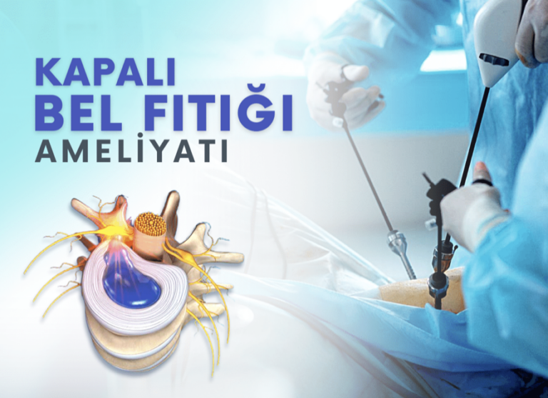 Bel Fıtığı ve Kapalı Ameliyat (Endoskopik Diskektomi) Yöntemi