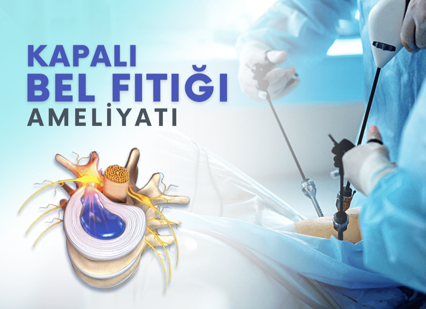Bel Fıtığı ve Kapalı Ameliyat (Endoskopik Diskektomi) Yöntemi